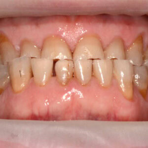Abrasione ed erosione dello smalto dei denti Abrasione ed erosione dello smalto dei denti