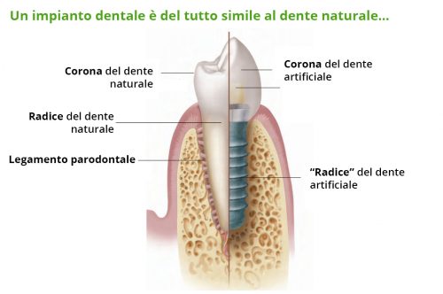 Impianto dentale e dente naturale