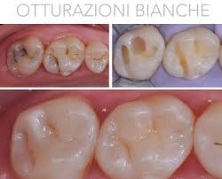 Otturazioni in composito estetico