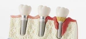 Periimplantite attorno all'impianto dentale