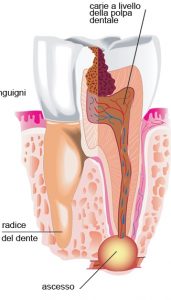 Immagine che mostra la formazione della carie dentale e le parti interne del dente.