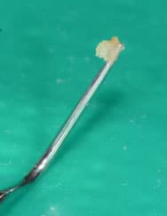 Strumento per rimuovere la placca batterica dai denti.