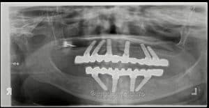Implantologia all on four