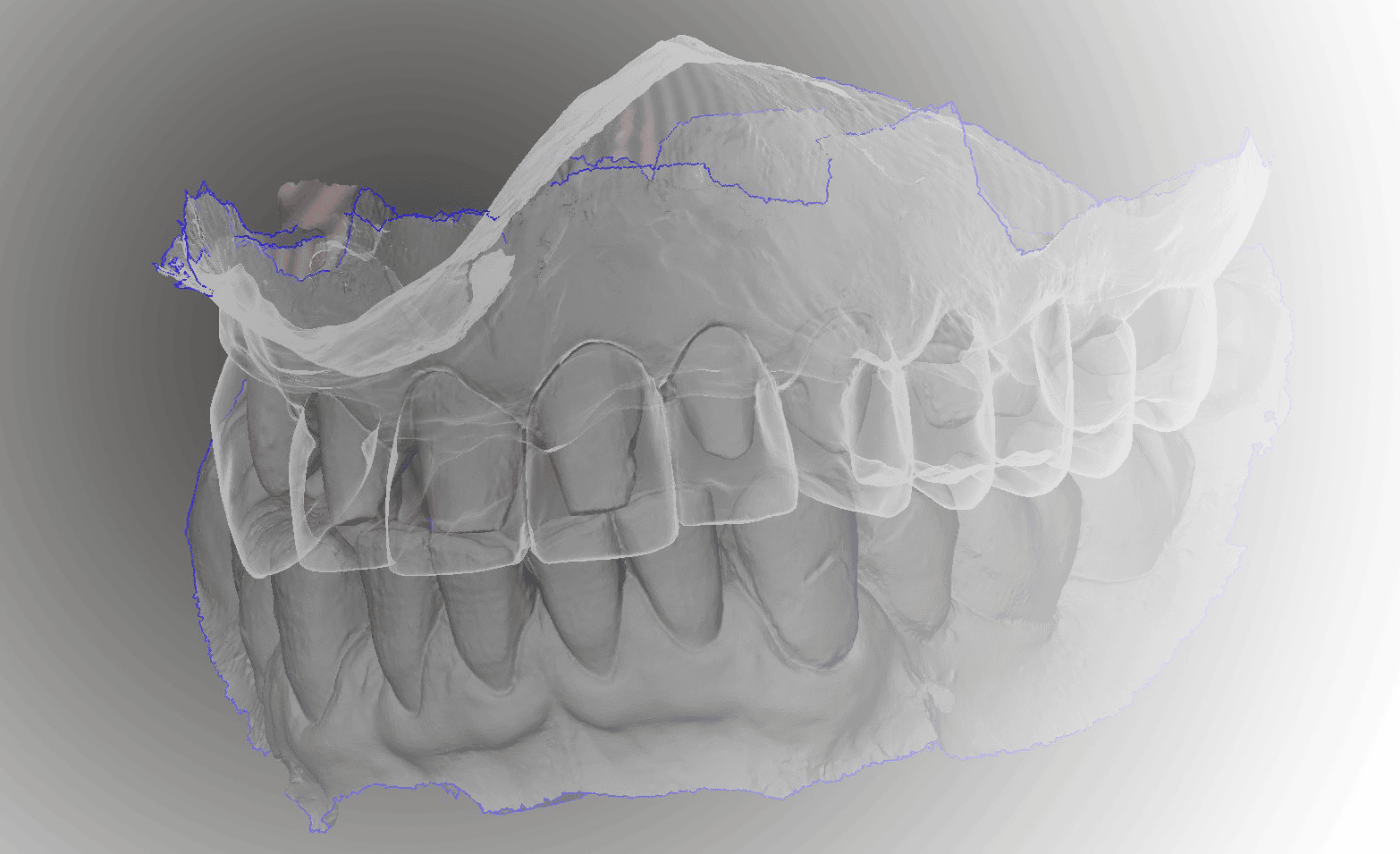 Rilievo di un modello di arcata dentale superiore in resina trasparente.