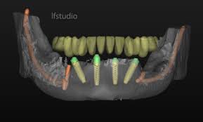 Immagine di una protesi implantare con impianti dentali in bocca.